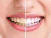 4 aliments qui blanchissent naturellement les dents