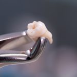 Bien se préparer à une intervention d’extraction de dents de sagesse…